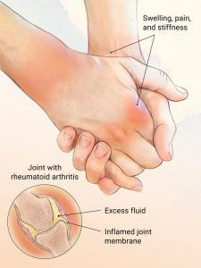 Rheumatoid Arthritis Diagram