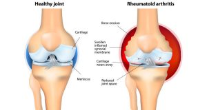 Rheumatoid Arthritis Diagram